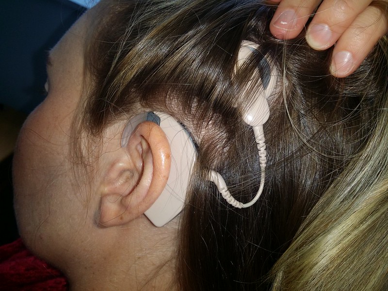 Cochlear Implant On Girl